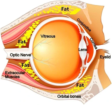 Medical diagram showing orbital fat anatomy including fat compartments, orbital septum, and eyelid structure around the eye